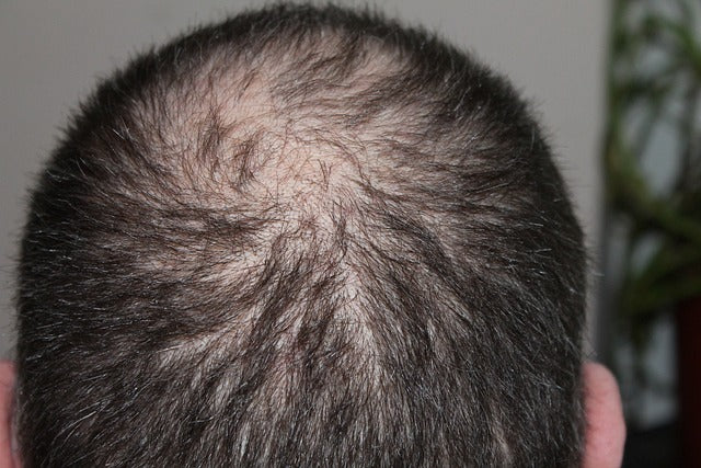 man losing his hair